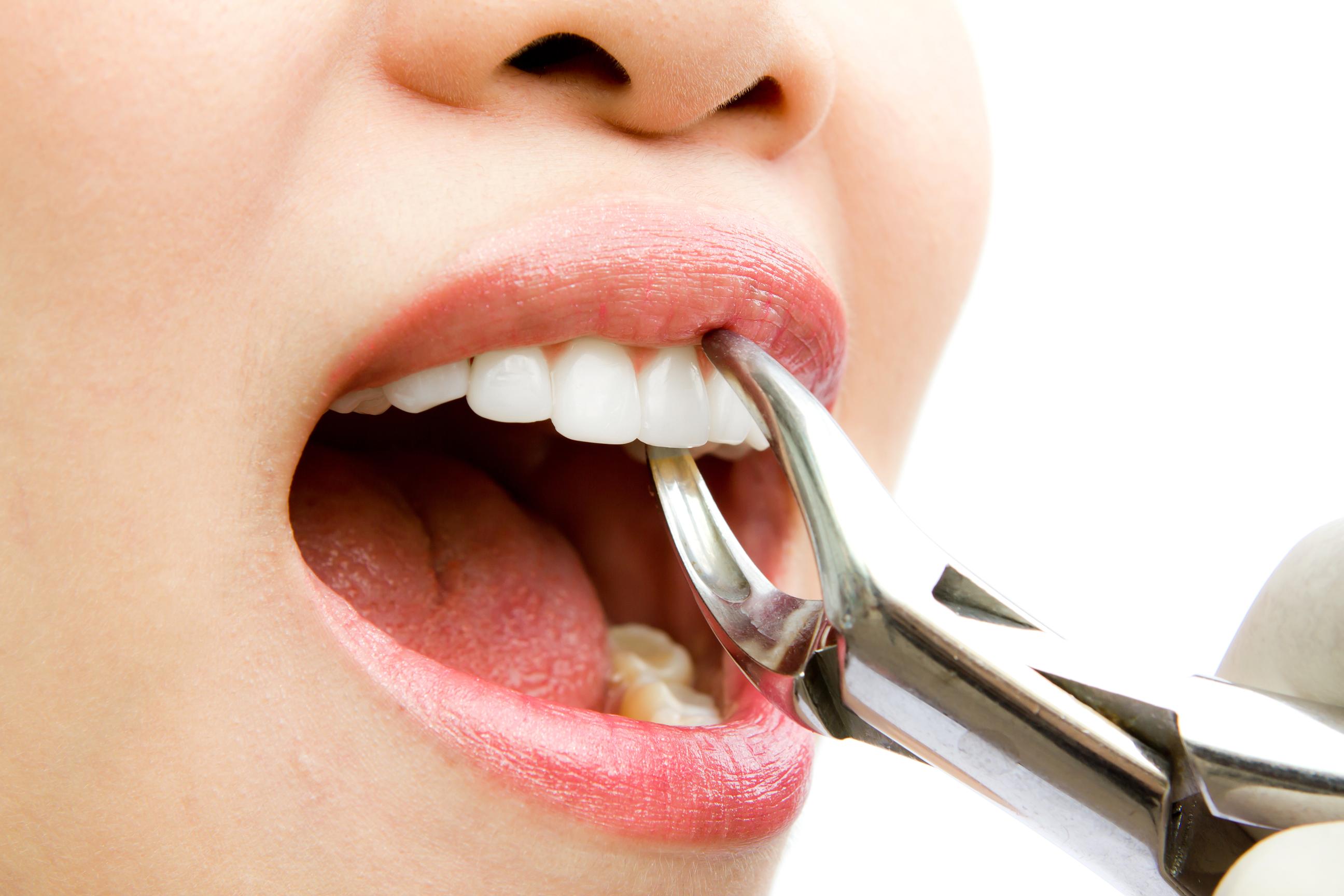 Teeth-Extraction - Copy