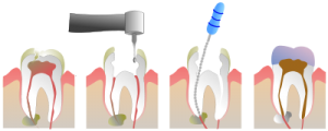 root-canal-2